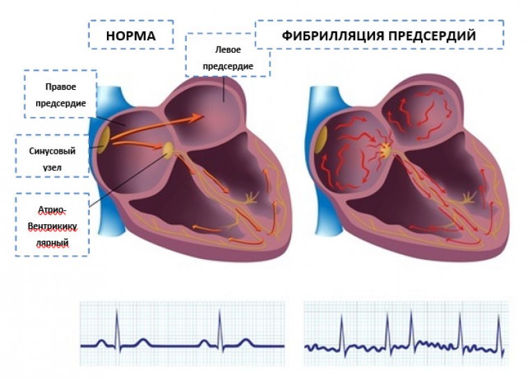 Прогностическое значение гиперурикемии у пациентов с фибрилляцией предсердий и сердечной недостаточностью с сохраненной фракцией выброса