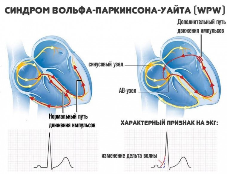 Случай синдрома вольфа-паркинсона-уайта и ранней реполяризации желудочков с высоким риском внезапной сердечной смерти
