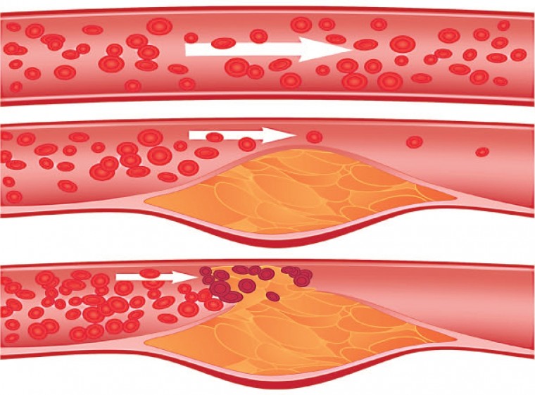 Стратификация риска развития атеросклероза коронарных артерий у пациентов с псориазом