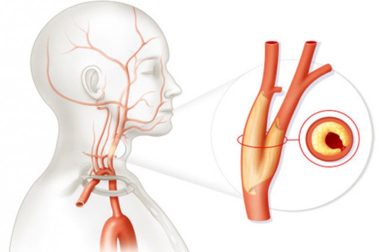Роль ультразвуковой визуализации субклинического атеросклероза сонных артерий в прогнозировании сердечно-сосудистого риска в рамках первичной кардиоваскулярной профилактики