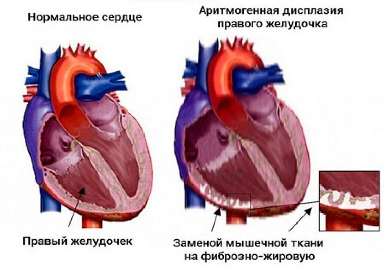 Аритмогенная кардиомиопатия правого желудочка: разработка днк-диагностики и клиническое применение