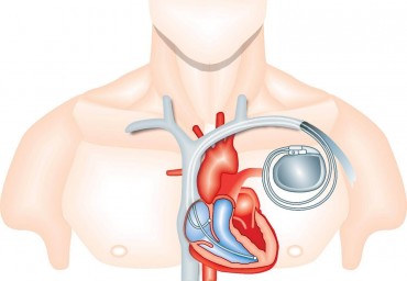 Способ экстракции петли электрода постоянной кардиостимуляции из правых отделов сердца через бедренный доступ