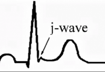 Пересмотр диагностических критериев синдромов J-волны: новые концепции и их актуальность для практики кардиолога