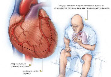 Оценка кислородтранспортной функции крови у пациентов с хронической сердечной недостаточностью ишемической этиологии в условиях применения внутривенного лазерного облучения крови