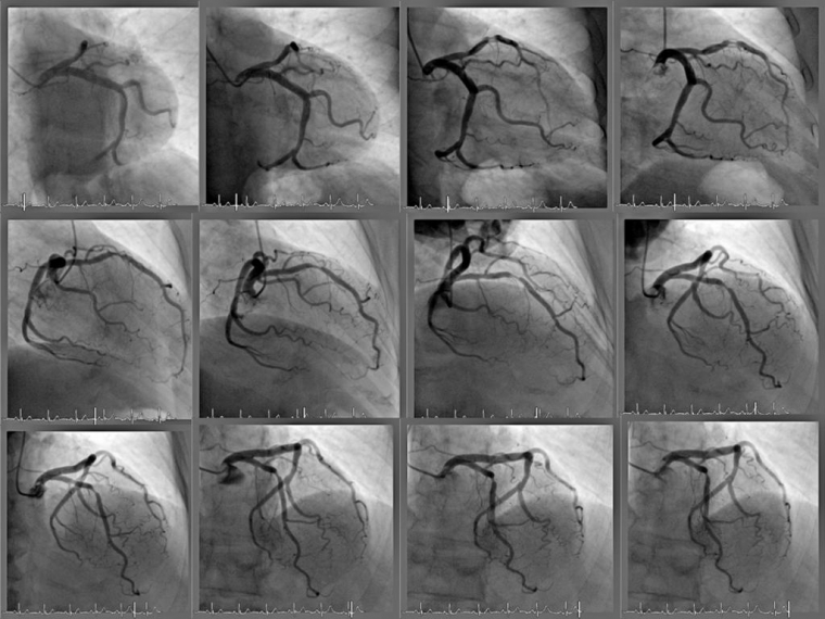 Возможности ультразвукового метода исследования эпикардиальной жировой ткани у пациентов с ишемической болезнью сердца при различной тяжести поражения коронарных артерий