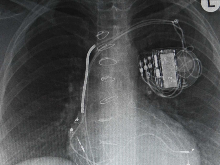 Миграция электрода временной электрокардиостимуляции в аорту: редкое осложнение после открытой операции на сердце