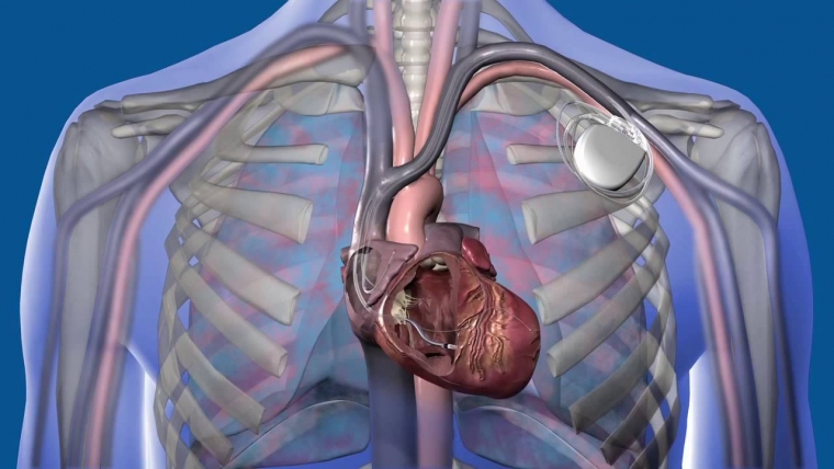 Роль кардиореабилитации у больных с имплантированными электрокардиостимуляторами