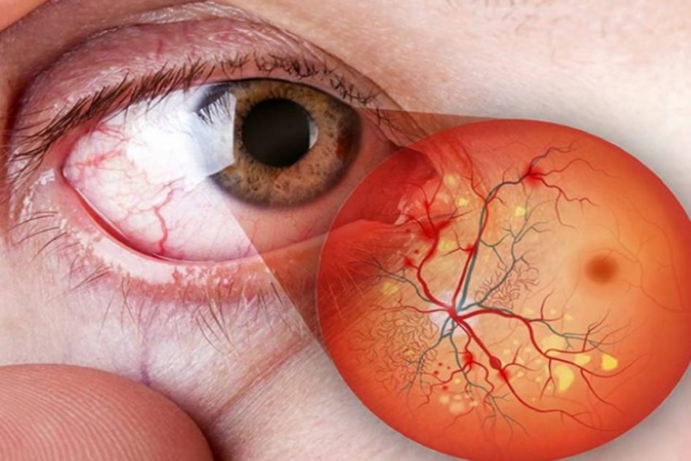 Диабетическая ретинопатия: средство для стратификации сердечно-сосудистого риска